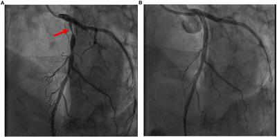 Case report: Sudden cardiorespiratory collapse in a healthy male after coronavirus disease 2019 vaccination at a vaccination center